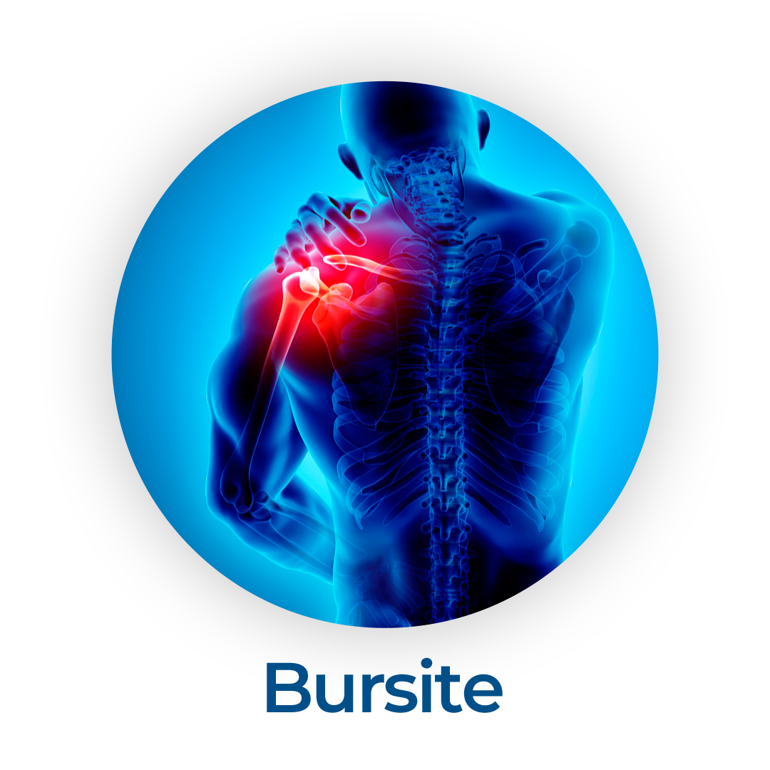 bursite