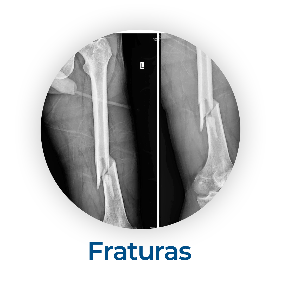 fraturas